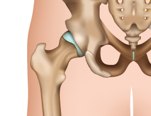 엉덩이(고관절) 인공관절 수술